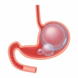  graphique représentant un ventre et des intestins ballonnés 