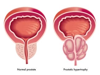  hypertrophie de la prostate